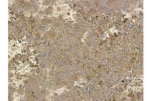 ABIN6257930 and ABIN6274821 at 1/100 staining human melanoma by IHC-P.