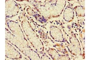 Immunohistochemistry of paraffin-embedded human gastric cancer using ABIN7160277 at dilution of 1:100 (MUC1 抗体  (AA 24-273))