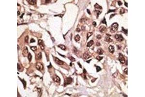 IHC analysis of FFPE human breast carcinoma tissue stained with the BMPR1A antibody (BMPR1A 抗体  (AA 21-51))