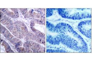 Immunohistochemical analysis of paraffin-embedded human colon carcinoma tissue using AMPK1/AMPK2 (Ab-485/491) antibody (E021130). (PRKAA1/PRKAA2 抗体)