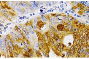 Immunohistochemistry of paraffin-embedded Human colon carcinoma using TFF1 Polyclonal Antibody at dilution of 1:200 (40x lens). (TFF1 抗体)