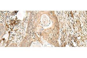 Immunohistochemistry of paraffin-embedded Human esophagus cancer tissue using ZNF397 Polyclonal Antibody at dilution of 1:80(x200) (ZNF397 抗体)