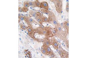 Formalin-fixed and paraffin-embedded human hepatocarcinoma tissue reacted with CYP3A5 antibody (C-term), which was peroxidase-conjugated to the secondary antibody, followed by DAB staining. (CYP3A5 抗体  (C-Term))
