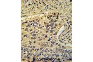 TAF2 Antibody (C-Term) immunohistochemistry analysis in formalin fixed and paraffin embedded human lung carcinoma followed by peroxidase conjugation of the secondary antibody and DAB staining. (TAF2 抗体  (C-Term))