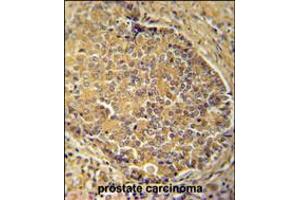IGSF1 antibody immunohistochemistry analysis in formalin fixed and paraffin embedded human prostate carcinoma followed by peroxidase conjugation of the secondary antibody and DAB staining. (IGSF1 抗体  (C-Term))