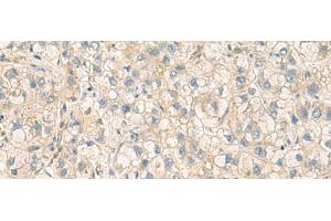 Immunohistochemistry of paraffin-embedded Human liver cancer tissue using PPM1M Polyclonal Antibody at dilution of 1:100(x200) (PPM1M 抗体)