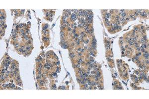 Immunohistochemistry of paraffin-embedded Human breast cancer using IPO7 Polyclonal Antibody at dilution of 1:40 (IPO7 抗体)