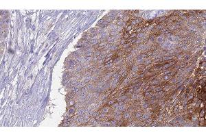 ABIN6276972 at 1/100 staining Human urothelial cancer tissue by IHC-P. (CD27 抗体  (Internal Region))