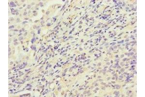 Immunohistochemistry of paraffin-embedded human lung cancer using ABIN7155154 at dilution of 1:100 (HK3 抗体  (AA 1-270))