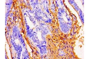 Immunohistochemistry of paraffin-embedded human colon cancer using ABIN7149775 at dilution of 1:100 (Desmoglein 1 抗体  (AA 384-539))