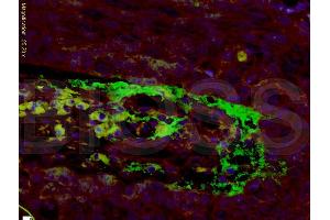 Formalin-fixed and paraffin embedded human laryngeal cancer tissue labeled with Anti-APOH Polyclonal Antibody, Unconjugated (ABIN731483) at 1:200 followed by conjugation to the secondary antibody, Goat Anti-Rabbit IgG, AF488 conjugated, and DAPI staining (APOH 抗体  (AA 281-345))