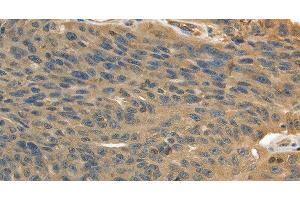 Immunohistochemistry of paraffin-embedded Human ovarian cancer using MSN Polyclonal Antibody at dilution of 1:30 (Moesin 抗体)