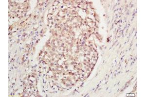 Formalin-fixed and paraffin embedded human laryngeal tissue labeled with Anti-DNA Polymerase gamma Polyclonal Antibody, Unconjugated  at 1:200 followed by conjugation to the secondary antibody and DAB staining. (POLG 抗体  (AA 1101-1239))