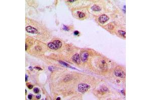 Immunohistochemical analysis of CYB5R3 staining in human liver cancer formalin fixed paraffin embedded tissue section. (CYB5R3 抗体  (Center))