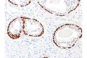 Formalin-fixed, paraffin-embedded human Prostate Cancer stained with p63 Rabbit Polyclonal Antibody. (p63 抗体)