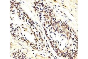 IHC analysis of FFPE human prostate carcinoma section using AKT1/2/3 antibody; Ab was diluted at 1:25. (AKT 1/2/3 抗体  (AA 278-312))