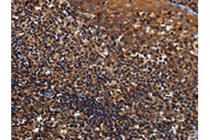 The image on the left is immunohistochemistry of paraffin-embedded Human tonsil tissue using ABIN7129963(KCNK17 Antibody) at dilution 1/60, on the right is treated with fusion protein. (KCNK17 抗体)