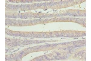 Immunohistochemistry of paraffin-embedded human endometrial cancer using ABIN7146874 at dilution of 1:100 (CSNK1G1 抗体  (Isoform gamma 1))