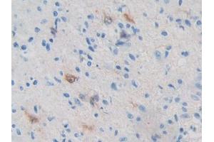 IHC-P analysis of Human Glioma Tissue, with DAB staining. (PRKAB2 抗体  (AA 17-260))