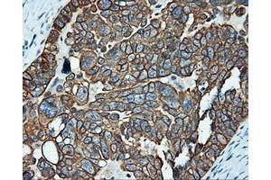Immunohistochemical staining of paraffin-embedded Adenocarcinoma of breast tissue using anti-SRR mouse monoclonal antibody. (SRR 抗体)