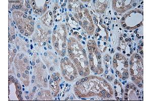 Immunohistochemical staining of paraffin-embedded Carcinoma of liver tissue using anti-TRPM4mouse monoclonal antibody. (TRPM4 抗体)