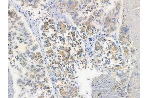 ABIN6260320 and ABIN6272259 at 1/100 staining human lung squamous cell carcinoma by IHC-P. (BTBD6 抗体  (Internal Region))