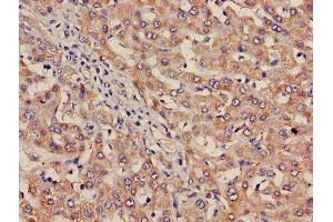 Immunohistochemistry of paraffin-embedded human liver cancer using ABIN7156456 at dilution of 1:100 (Integrin Alpha2b 抗体  (AA 639-887))