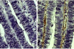 Paraffin embedded human gastric cancer tissue was stained with Goat IgG-UNLB isotype control, DAB, and hematoxylin. (Collagen Type V 抗体  (Biotin))