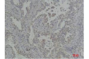 Immunohistochemistry (IHC) analysis of paraffin-embedded Human Lung Carcinoma using Bcl-XlRabbit Polyclonal Antibody diluted at 1:200. (BCL2L1 抗体)