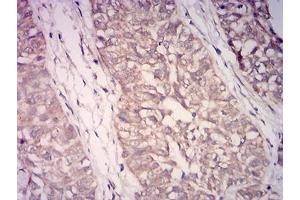 Immunohistochemical analysis of paraffin-embedded bladder cancer tissues using WDFY3 mouse mAb with DAB staining. (WDFY3 抗体  (AA 3277-3526))