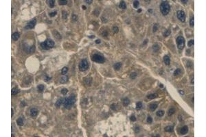 Detection of Hpt in Human Liver cancer Tissue using Monoclonal Antibody to Haptoglobin (Hpt) (Haptoglobin 抗体  (AA 168-319))