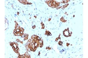Formalin-fixed, paraffin-embedded human Breast Carcinoma stained with Cytokeratin-7 Mouse Monoclonal Antibody (KRT7/2200).