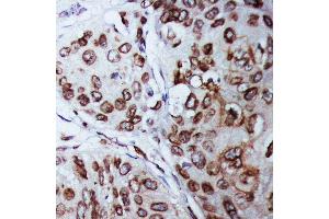 Anti-Lamin B1 antibody, IHC(P) IHC(P): Human Mammary Cancer Tissue (Lamin B1 抗体  (C-Term))