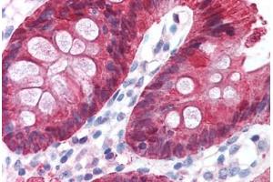 Human Colon (formalin-fixed, paraffin-embedded) stained with CA2 antibody ABIN214579 at 5 ug/ml followed by biotinylated goat anti-rabbit IgG secondary antibody ABIN481713, alkaline phosphatase-streptavidin and chromogen. (CA2 抗体)