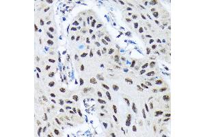 Immunohistochemistry of paraffin-embedded human lung cancer using SMN1 Rabbit mAb (ABIN7270651) at dilution of 1:100 (40x lens). (SMN1 抗体)