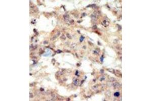 Formalin-fixed and paraffin-embedded human cancer tissue reacted with the primary antibody, which was peroxidase-conjugated to the secondary antibody, followed by DAB staining. (EPH Receptor B6 抗体  (N-Term))