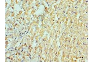 Immunohistochemistry of paraffin-embedded human liver cancer using ABIN7150066 at dilution of 1:100