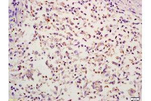 Formalin-fixed and paraffin embedded human colon carcinoma labeled with Anti-HMGB4 Polyclonal Antibody, Unconjugated (ABIN734918) at 1:200 followed by conjugation to the secondary antibody and DAB stainin (HMGB4 抗体  (AA 31-130))