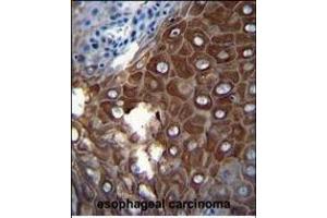 P1 Antibody (Center) (ABIN655817 and ABIN2845241) iunohistochemistry analysis in formalin fixed and paraffin embedded human esophageal carcinoma followed by peroxidase conjugation of the secondary antibody and DAB staining. (MMP1 抗体  (AA 317-347))