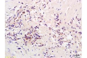 Formalin-fixed and paraffin embedded human colon carcinoma labeled with Rabbit Anti AADAC Polyclonal Antibody, Unconjugated (ABIN1387867) at 1:200 followed by conjugation to the secondary antibody and DAB staining (AADAC 抗体  (AA 228-273))