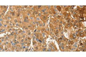 Immunohistochemistry of paraffin-embedded Human liver cancer tissue using ANXA9 Polyclonal Antibody at dilution 1:30 (Annexin A9 抗体)