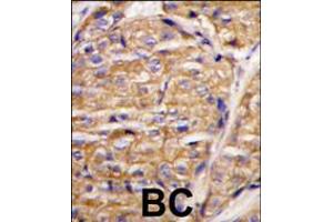 Formalin-fixed and paraffin-embedded human breast carcinoma tissue reacted with MIPEP antibody , which was peroxidase-conjugated to the secondary antibody, followed by DAB staining. (MIPEP 抗体  (N-Term))