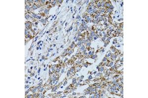 Immunohistochemistry of paraffin-embedded human lung cancer using ATP5B antibody (ABIN5973391) at dilution of 1/100 (40x lens). (ATP5B 抗体)