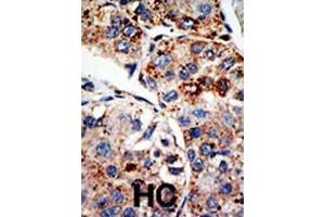 Formalin-fixed and paraffin-embedded human cancer tissue reacted with the primary antibody, which was peroxidase-conjugated to the secondary antibody, followed by DAB staining. (DOT1L 抗体  (C-Term))