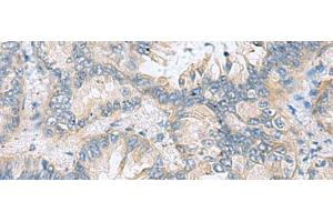 Immunohistochemistry of paraffin-embedded Human lung cancer tissue using TAGLN3 Polyclonal Antibody at dilution of 1:70(x200) (Transgelin 3 抗体)