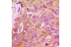 Immunohistochemical analysis of IRS1 (pS1101) staining in human breast cancer formalin fixed paraffin embedded tissue section. (IRS1 抗体  (C-Term, pSer1101))