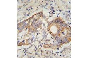 Immunohistochemistry analysis in formalin fixed and paraffin embedded human colon carcinoma reacted with AP52042PU-N, which was peroxidase conjugated to the secondary antibody and followed by DAB staining. (HHLA2 抗体  (N-Term))