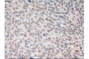 Immunohistochemical staining of paraffin-embedded Adenocarcinoma of breast tissue using anti-VEGF mouse monoclonal antibody. (VEGF 抗体  (AA 27-233))
