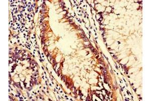 Immunohistochemistry of paraffin-embedded human colon cancer using ABIN7147114 at dilution of 1:100