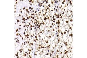 Immunohistochemistry of paraffin-embedded human well-differentiated squamous skin carcinoma using PHIP antibody at dilution of 1:100 (40x lens). (PHIP 抗体)
